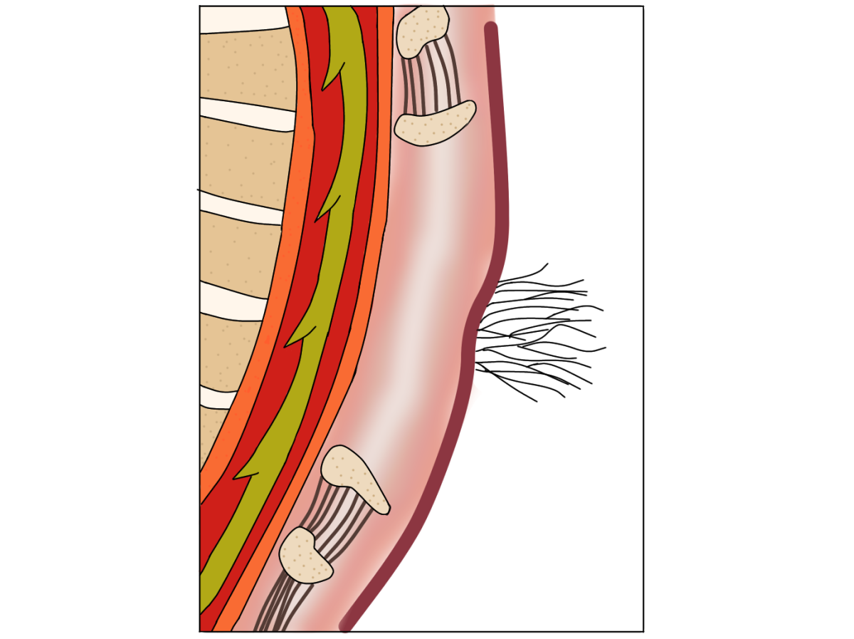 Spina bifida caché